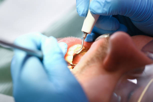Best Emergency Treatment for Dental Infections or Abscesses in Boulevard Gardens, FL